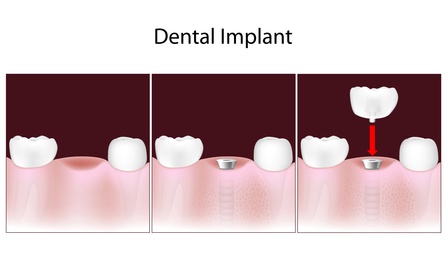 Dental implants