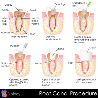 Root Canal Treatment