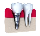 Dental Implants will Match Your Natural Teeth