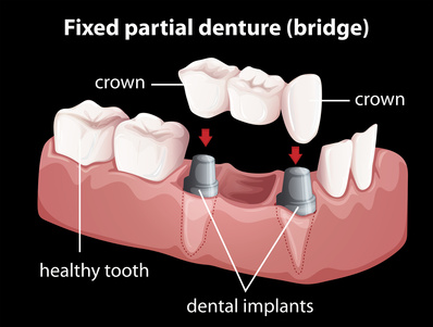 What Restorative Dentistry Can Do For You