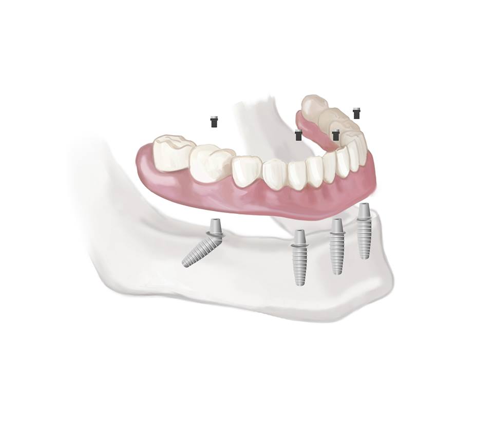 Denture implant